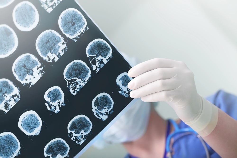 Los Angeles Brain Injury Lawyer